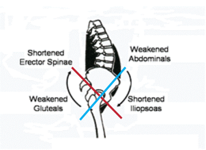 Pelvis_imbalance